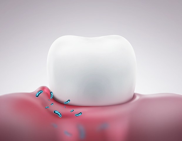 치아 주변 잇몸에 세균으로 염증이 생긴 모습의 일러스트