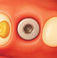 빠른 뼈이식 6단계 - 뼈가 회복된 자리에 임플란트 식립