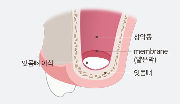 상악동 막을 들어 올리고 잇몸뼈를 이식하는 구조를 보여주는 그림