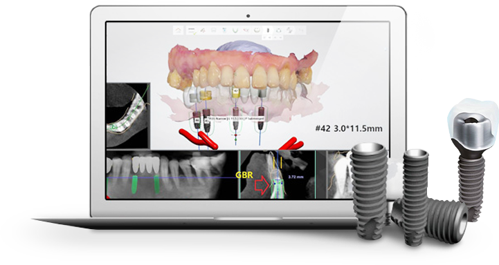 3D CT 데이터로 임플란트 식립 위치를 계획하는 화면과 임플란트